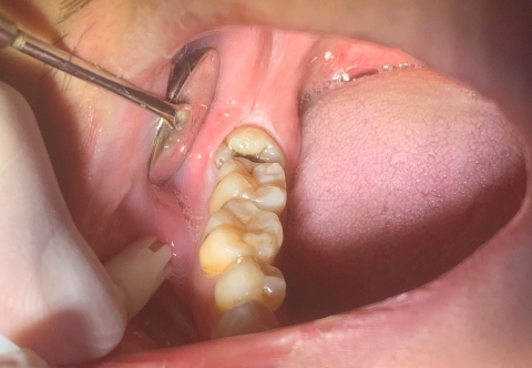 Nhổ Răng Khôn Chảy Máu Bao Lâu? Bao Lâu Thì Lành?